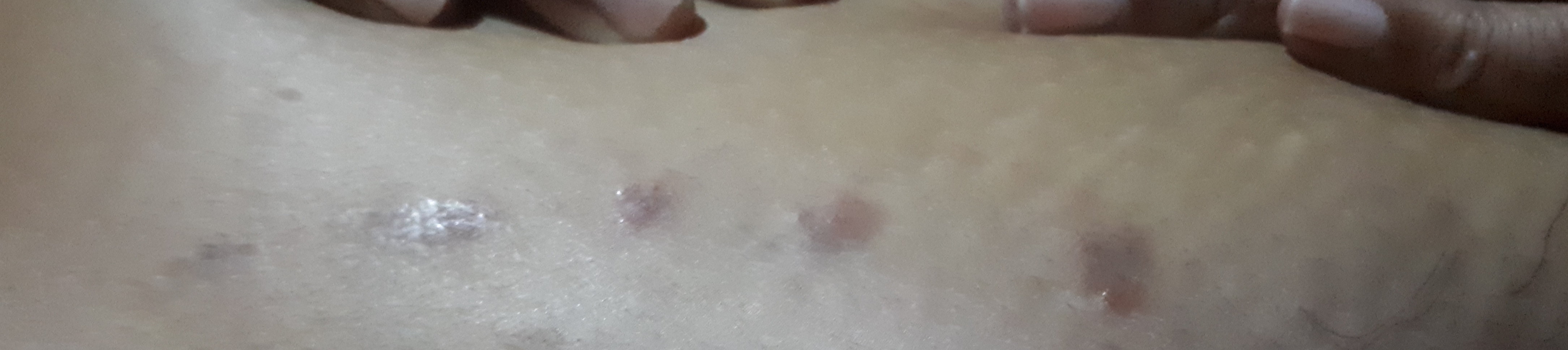 39 Years Old Lady With Severe Itching